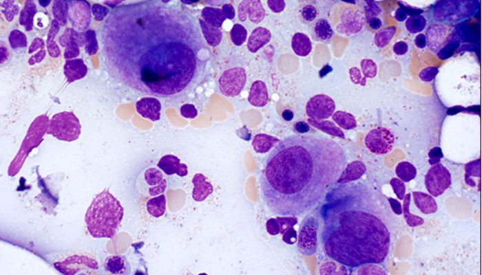 bonemarrowneoplasticMDSWHOZhang06